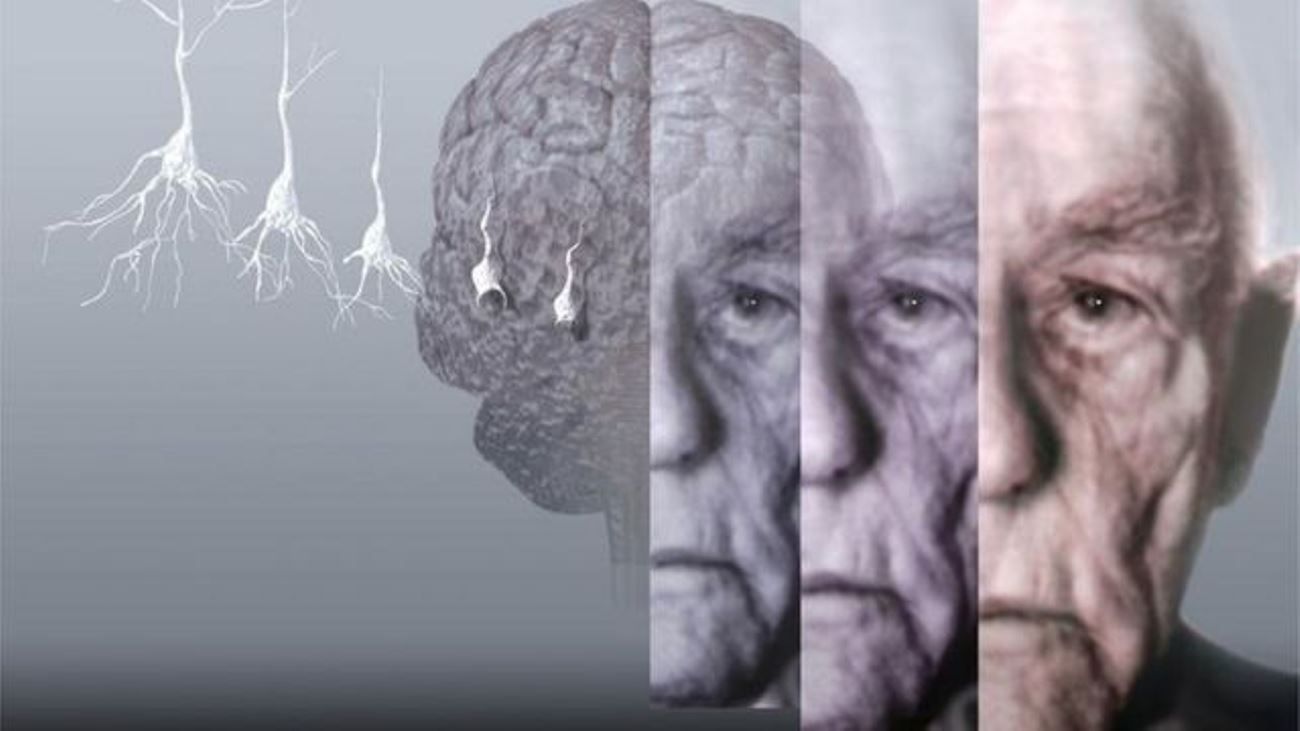 5 признаков начинающегося Альцгеймера