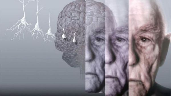 5 признаков начинающегося Альцгеймера